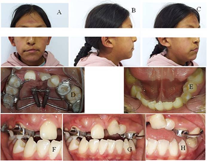 Tratamiento Ortop Dico Del Disyuntor En Abanico Y M Scara Facial Caso